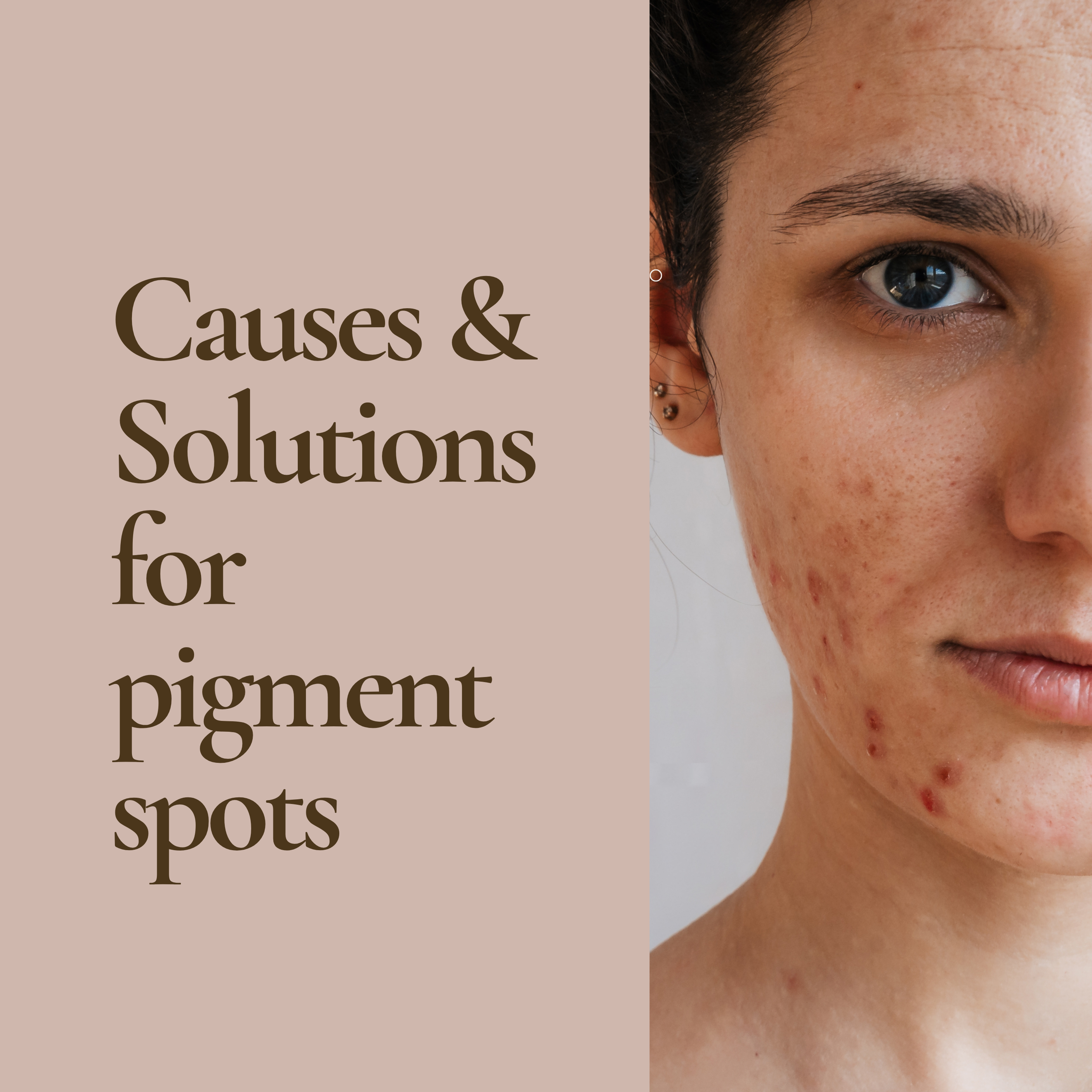 Oorzaken en oplossingen van pigmentvlekken